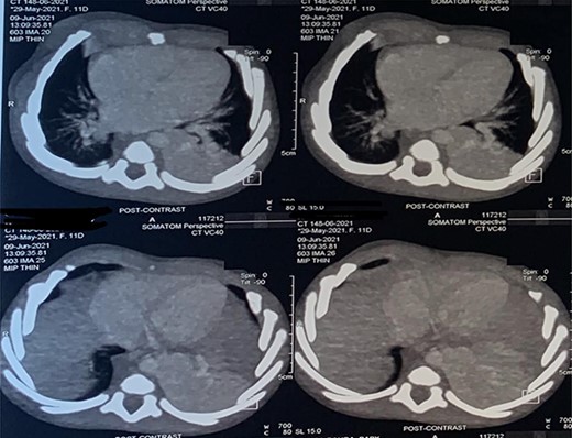 CT scan images depicting intralobar pulmonary sequestration of the left lower lung lobe.