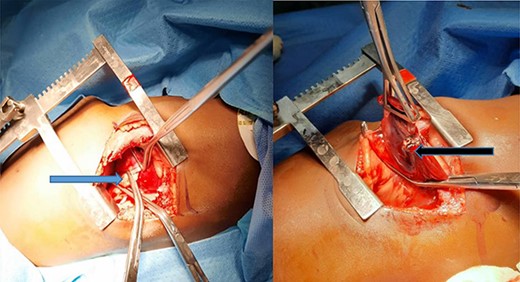 (A) Blue arrow showing the anomalous artery from the descending thoracic aorta; (B) black arrow showing the erythematous and dense sequestrated lung.