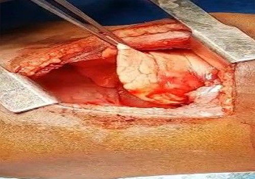 The normal lung after anomalous artery ligation and wedge resection of the sequestrated lung.