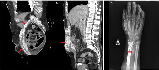 HO demonstrated on computed tomography (CT) imaging and X-ray after traumatic Injuries. (A) Coronal image of HO and (B) Sagittal image of HO on CT abdomen and pelvis demonstrating sites of HO (red arrows). (C) X-ray of right forearm between ulna and radius showing HO (red arrows).
