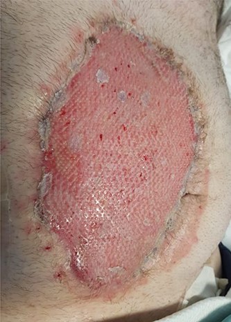 Split thickness skin graft for abdominal incision closure.