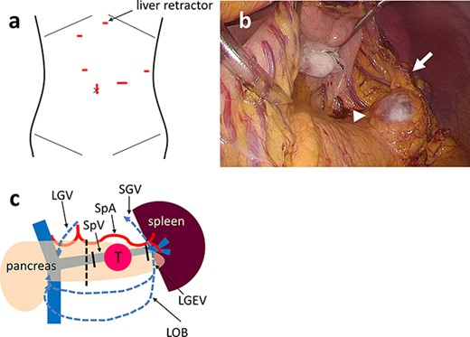 (a) One transumbilical access port is created for videolaparoscopy and working trocars are inserted into four other ports. A Nathanson hook liver retractor is placed in the subxiphoid location (arrow). (b) Intraoperative photograph of Case 3 showing that the stomach and lateral segment of the liver are retracted by the retractor. The cystic tumor (arrowhead) is exposed optimally even if the omental branches of the left gastroepiploic vessels remain (arrow). (c) Schema of laparoscopic SPDP-VRes. The pancreas is divided at the dissection line (dotted line). The splenic vein is divided at the proximal side of tumor and the pancreatic tail (solid line), preserving the confluence of the SGV, the LGEV and the LOB. The three drainage routes from the spleen are indicated by the blue dotted arrows: the arcade of the GEV; the arcade of the omental vein and the SGV to the LGV via the stomach wall. PV: portal vein, SMV: superior mesenteric vein, SpV: splenic vein, SpA: splenic artery, T: tumor.