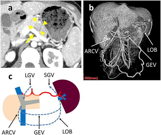 (a) Contrast-enhanced CT shows a 25-mm tumor in the pancreatic body (arrowhead) that is in wide contact with the splenic vein (arrow). (b) 3D reconstruction image shows a dilated GEV and the arcade that is formed by the LOB and ARCV. (c) Schema of venous return in Case 1. The blood flow from the spleen flows into the portal vein through three main routes: LOB to ARCV; the SGV to the LGV via the stomach wall; and GEV.