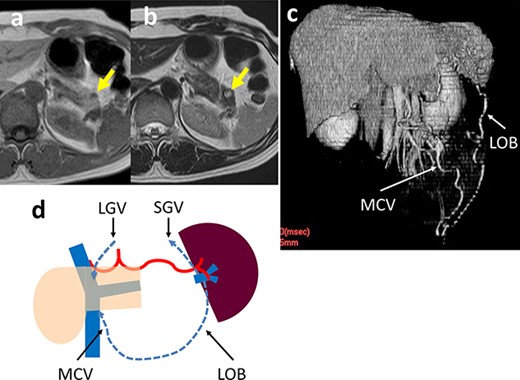 (a, b) Contrast-enhanced MRI shows a 5-mm tumor in the pancreatic tail (arrow) that has a low-signal intensity on T1-weighted images and a high-signal intensity on T2-weighted images. (c) 3D reconstruction image shows an arcade formed by the dilated LOB and MCV. (d) Schema of venous return in Case 2. The blood flows from the spleen into the SMV/PV through two main routes: LOB to MCV; and the SGV to the LGV via the stomach wall.