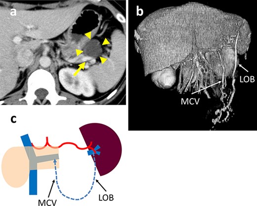 (a) Contrast-enhanced CT shows a 35-mm cystic tumor in the pancreatic tail (arrowhead) which is in contact with the splenic vein (SpV) (arrow). (b) 3D reconstruction image shows the arcade formed by the dilated LOB and MCV. (c) Schema of venous return in Case 3. The blood flows from the spleen into the PV via the LOB to the MCV and SpV.