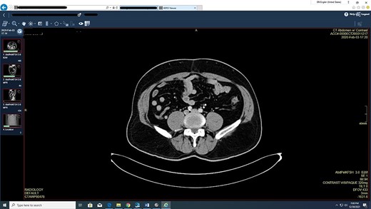 Appendix slightly enlarged especially at the base measuring 11 mm with dilated tip measures 7 mm, but no evidence of adjacent inflammatory stranding or abnormal fluid collection.
