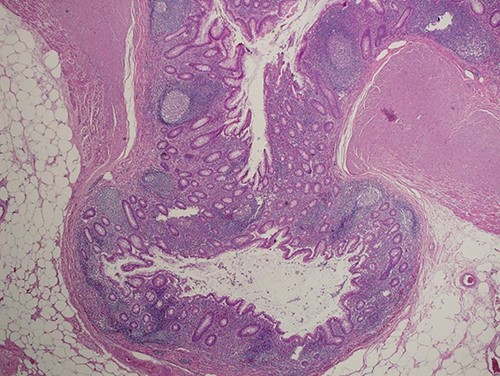 Section shows herniation of mucosa and muscularis mucosa through wall of the appendix without inflammation or dysplastic changes (hematoxylin and eosin, ×100).