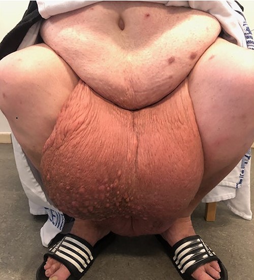 Scrotum appearance 2 years prior excision surgery.