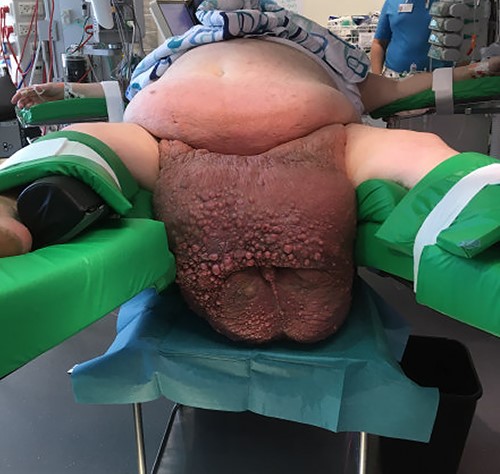 Preoperative view of scrotum.