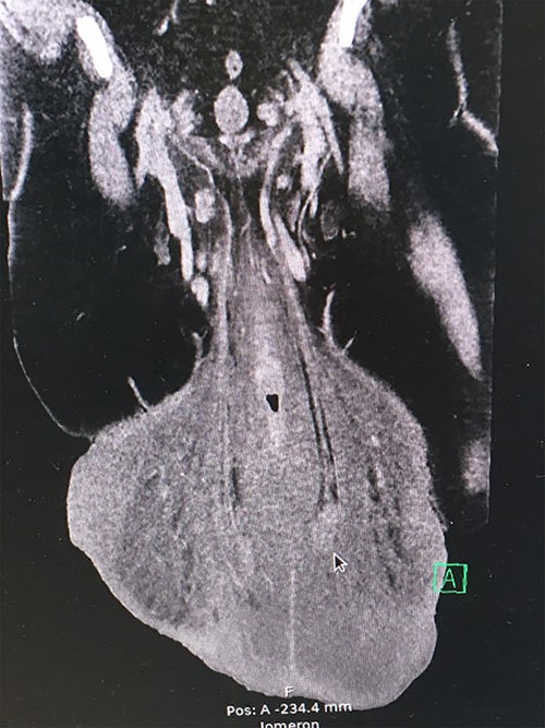 Preoperative frontal view CT-scan.