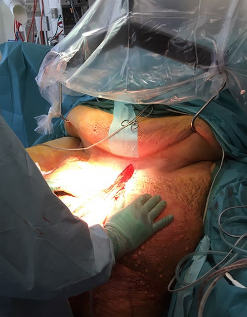 Lifting the abdominal pannus with S-hooks.