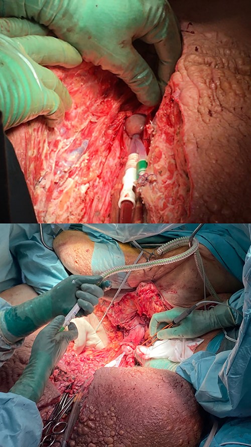 Sagittal incision of the scrotum until glans penis exposure and handmarking a small portion of the inverted preputium.