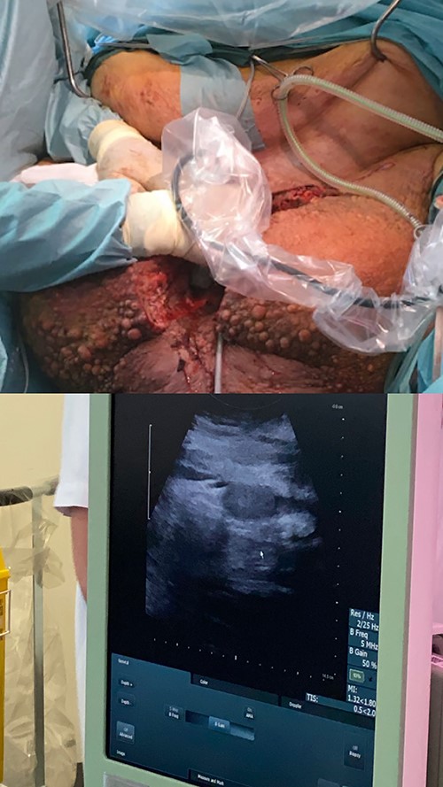 Perioperative location of testes using ultrasound.