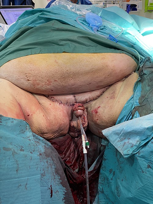 Postoperative view after advancement of the lateral scrotal wall to the prepubic incisions lines. The penis remains degloved until secondary reconstruction.