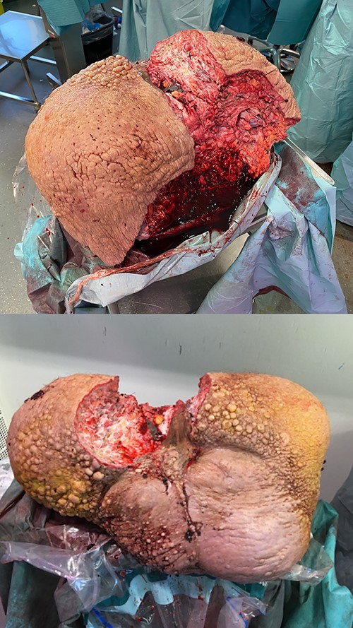 Removed scrotal mass specimen of 26 kg. Frontal and posterior view of the specimen.