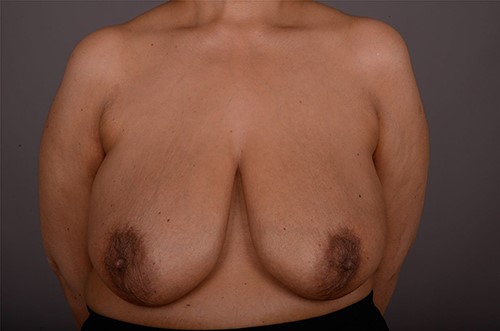 View of both breasts at initial presentation.