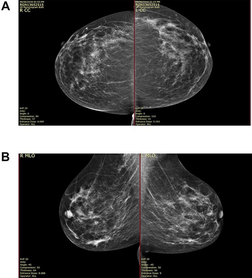 (A) Mammography showed widespread segmental distribution of pleomorphic calcification on the right breast measuring up to 11 cm; (B) mammography showed widespread segmental distribution of pleomorphic calcification on the right breast measuring up to 11 cm.