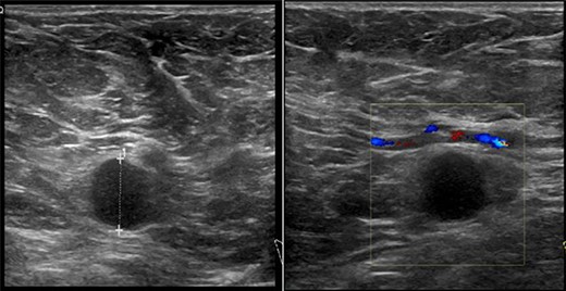 US findings of abnormal lymph node in right axilla.