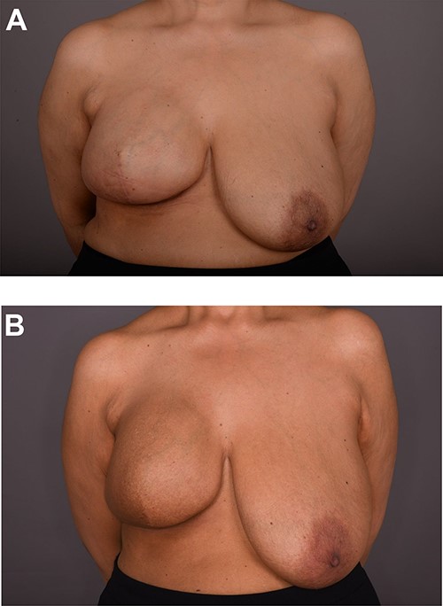 (A) 3 months post-op; (B) post-radiotherapy.