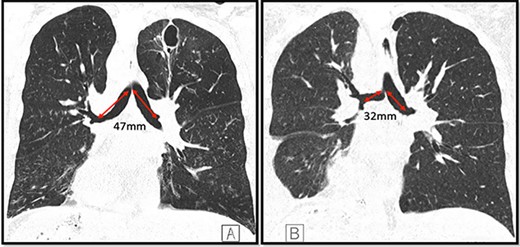Coronal CT images depicting both main bronchi with the length of 47 mm prior to the lung transplantation (A); length of both main bronchi post transplantation is ~32 mm; the right main bronchus is now at an approximate right angle with the trachea (B); note the presence of dextrocardia in both images and a thin-walled postinfectious left upper lobe cavity in the native lung.