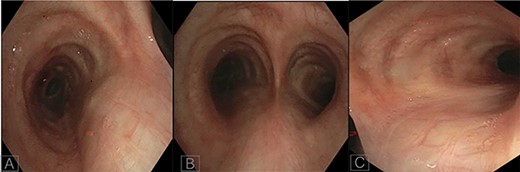 Bronchoscopy images of left main bronchus (A), carina (B) and right main bronchus post transplantation (C).