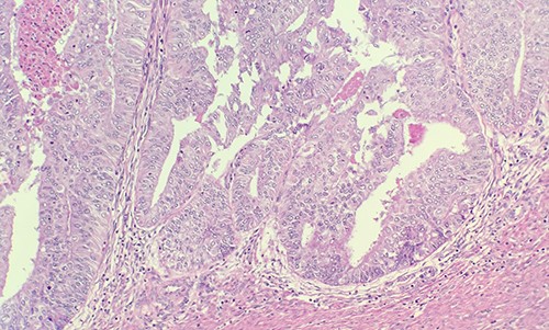 Microscopic examination of endometrial reveals endometrial adenocarcinoma, endometrioid type, FIGO Grade 2 (H&E ×20).