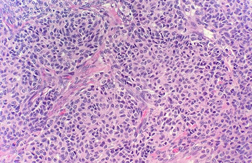Microscopic examination of ovary shows solid growth of tumor cells with angulated pale nuclei and nuclei grooves (H&E ×40).