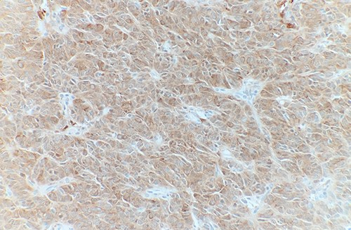 Tumor cells are positive for Calretinin by immunohistochemical stain (IHC ×40).