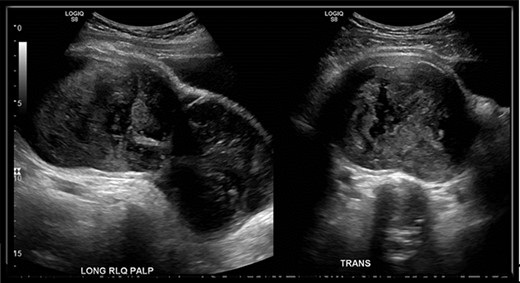 US of right lower quadrant visualizing the hypo-vascular abdominal mass longitudinally and transversely; mass measured 18.5 × 8.1 × 11 cm in the right hypogastric region with only a small amount of visible internal flow on color Doppler.