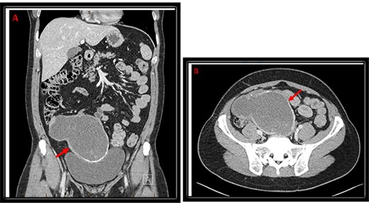 Coronal (A) and transverse (B) cuts of CT abdomen/pelvis demonstrating a large complex mass (red arrow) extending from the central pelvis to the right lower quadrant of the abdomen with some calcifications at the inferior and medial edges with some internal calcifications.