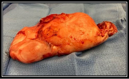 Resected LAMN gross specimen; brown to tan in color, weighed 264 g and measured 17.5 × 11.0 × 4.0 cm.