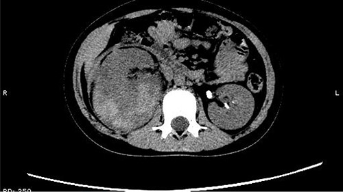 Some irregular high-density shadows was present in the left renal pelvis.