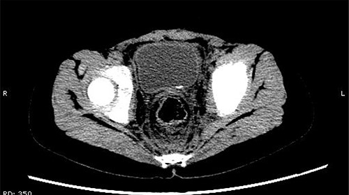 A small strip of high-density shadow was present in the bladder cavity.