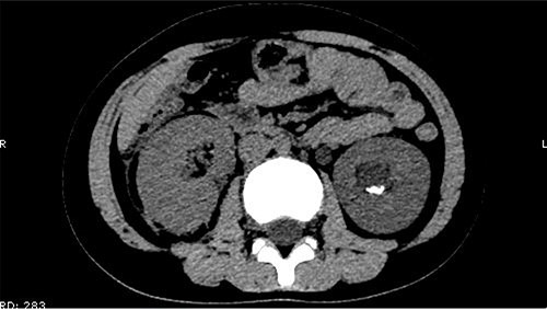 Some irregular high-density shadows persisted in the left renal pelvis, hydronephrosis was apparent in the left renal pelvis.