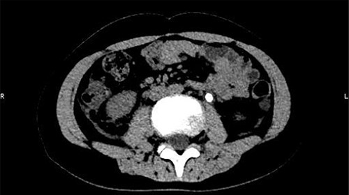 An irregular high-density shadow was present in the left upper ureter.