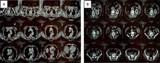 Thoracic-abdominal and pelvic computed tomography (CT) images showing on the thoracic level (A) a poorly limited mass measuring 27 × 22mm in the upper outer quadrant of the left breast (B) and a single left kidney at the abdomino-pelvic level.