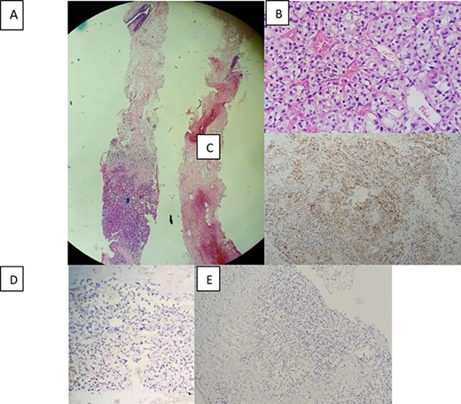 Morphological and immunohistochemical aspect: (A) Breast localisation of tumor proliferation (hematoxylin-eosin, magnification_40). (B)consisting of nests of cells with clear cytoplasm and a regular network of blood vessels (hematoxylin-eosin, magnification_400). (C) Immunohistochemical staining showing positive expression of CD10 in tumor cells (magnification_100). (D) Positive nuclear expression of PAX8 (magnification_200). (E) and negative expression of GATA3 (magnification _100).