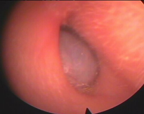Mass of the right external auditory canal.