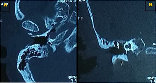 Axial (A) and coronal (B) CT scans showing a tissue lesion process of the external auditory canal with erosion of the eardrum and filling of a few mastoid cells.