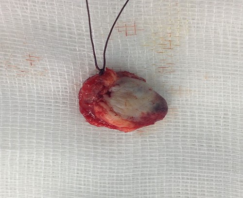 Surgically resected specimen.