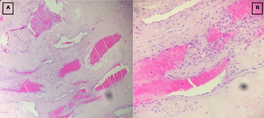 Images showing the fibroblastic (A) and vascular (B) components of the tumor.