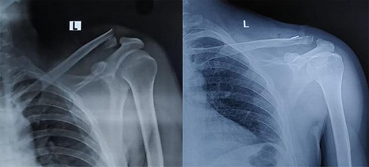 Pre op and 1-year follow-up X-ray image of Neer’s type II unstable lateral end clavicle fracture.