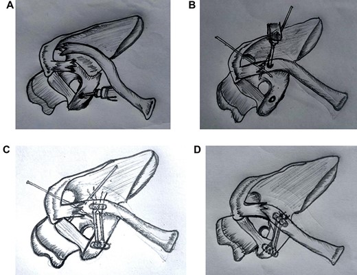 (A) After exposing coracoid a drill hole was made at the base Coracoid with 3.2-mm drill bit. (B) Fracture reduced and provisionally fixed with k wire and a Drill hole was made over clavicle medial to fracture. (C) Fibre tape entangled in endobutton passed through drill hole of coracoid and subsequently through a drill hole of clavicle with the help of 26G ss wire. (D) Final construct with second endobutton over clavicle and fibre tape tied followed by removal of k - wire.