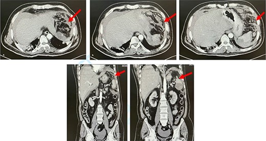 CT abdomen. Axial and coronal views showing splenic rupture and hemoperitoneum (red arrow).