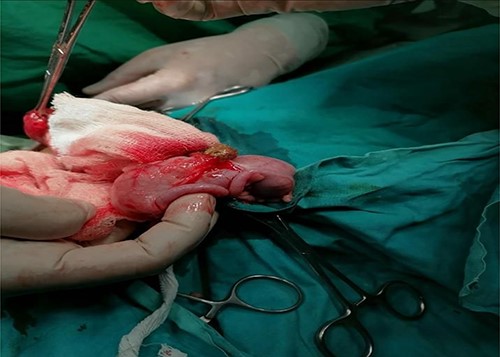 Double appendix shown as attached to the base of cecum.