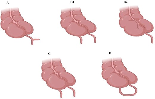 Type A shows partially duplicated appendix, Type B shows two discreet appendices, B1 bird beak like, B2 tenia coli, Type C has a duplicated cecum.