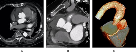 Preoperative contrast-enhanced CT; (A) a pseudoaneurysm was found in the aortic root; (B) the RCA appeared to originate from the pseudoaneurysm; (C) 3D CT showed the same results.