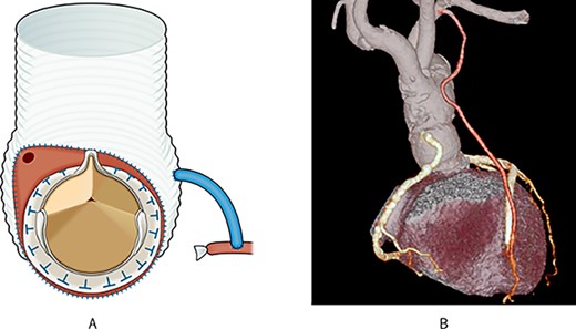Post-operative schema and 3D CT; (A) the aortic root was resected diagonally, and AVR was performed; next, the vascular graft was anastomosed to the aortic root; finally, the right coronary artery was translocated using an SVG; (B) post-operative 3D CT showed that the pseudoaneurysm disappeared, and all grafts were patent.