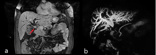 Magnetic resonance imaging (MRI): (a) coronal scan showing the dilatation of bile ducts and the thickening of the MBD (red arrow); (b) magnetic resonance cholangiopancreatography (MRCP) showing the dilatation of intrahepatic bile ducts and the absence of signal from the MBD below the confluence to the papilla of Vater.
