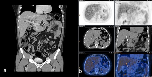 (a) Venous phase of the CT scan showing the dilated biliary tree and the contrast-enhanced thickening of the common bile duct. (b) 18-FDG-PET/CT scan showing the slight uptake of marked glucose along the common bile duct.